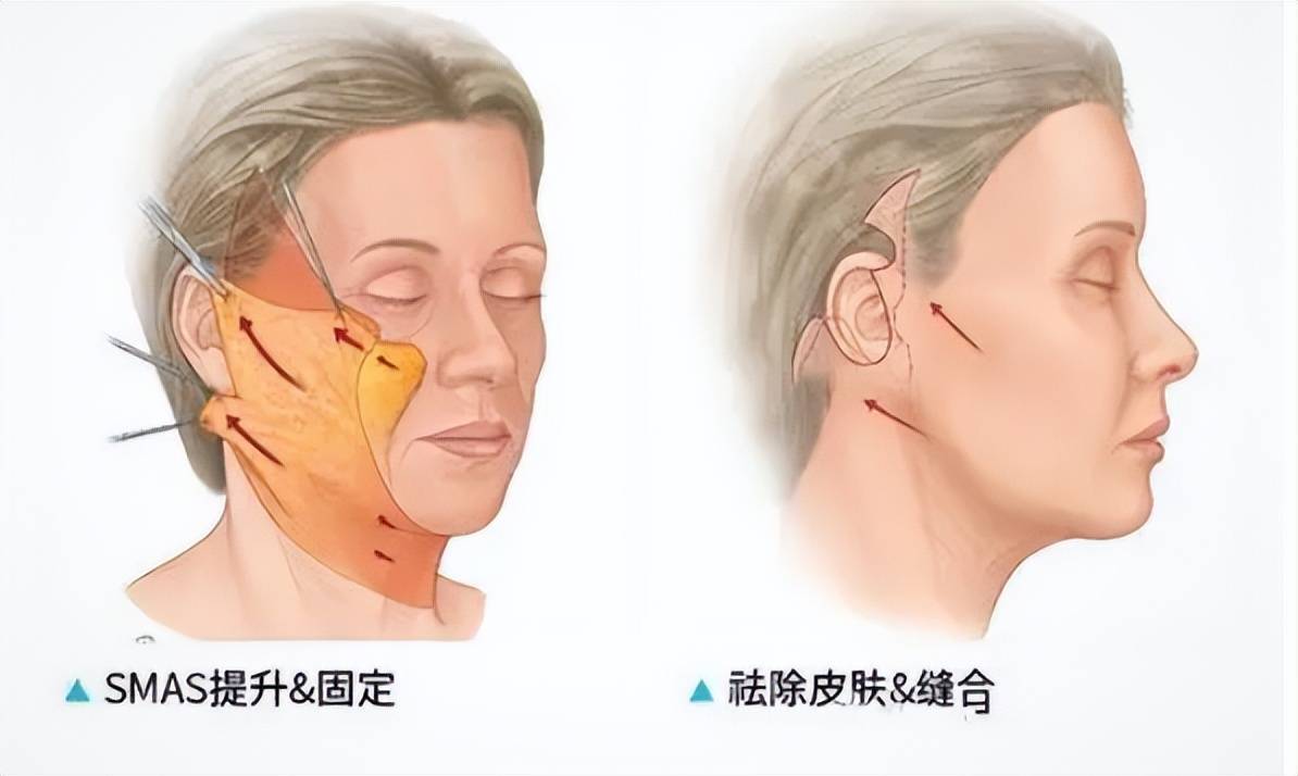 筋膜悬吊能维持多久?筋膜悬吊术可以维持几年?