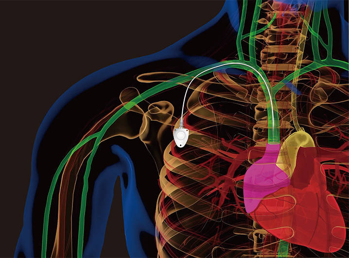 乳腺癌患者中心静脉血管通路的选择策略_病人_癌症_中国