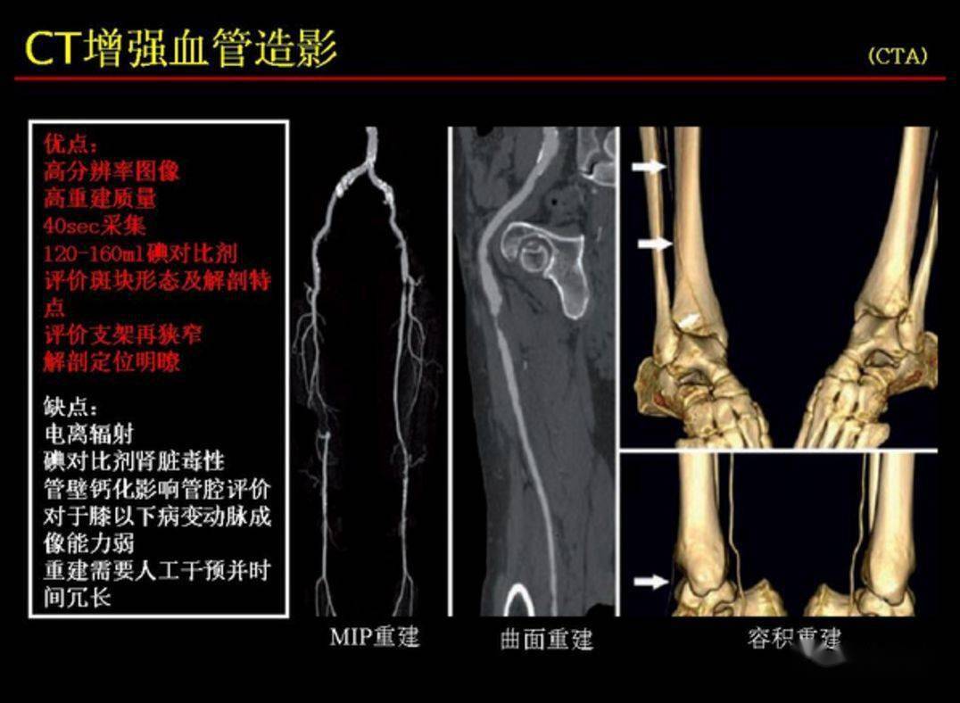 下肢动脉CTA解剖图片