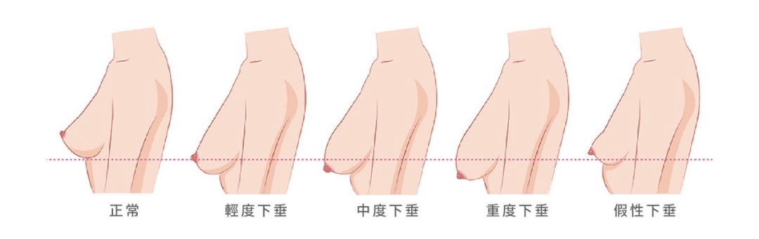 女生不穿内衣,胸会下垂吗?