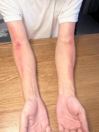 2,颈项部脊柱和两侧膀胱经也可以刮痧,具体线路见上面图文,儿童可以