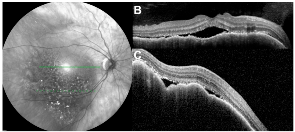 图7. 脉络膜转移癌的oct表现cm与其他眼内原发性肿瘤oct鉴别要点:图8.