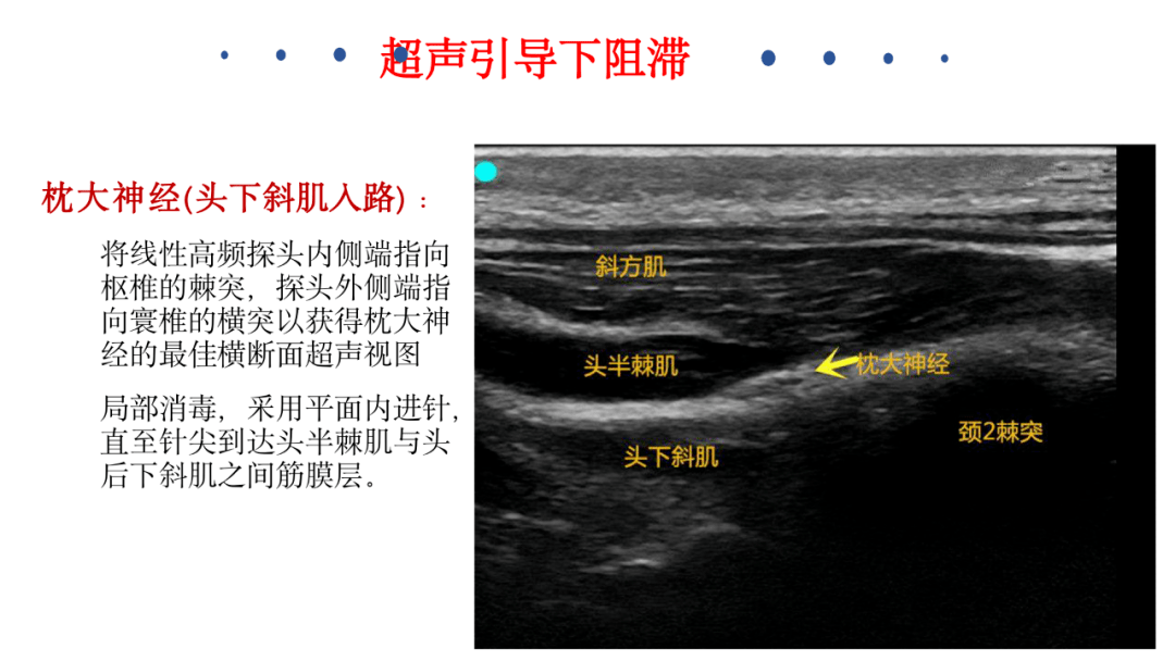 頭皮神經阻滯_麻醉_鎮痛_作用