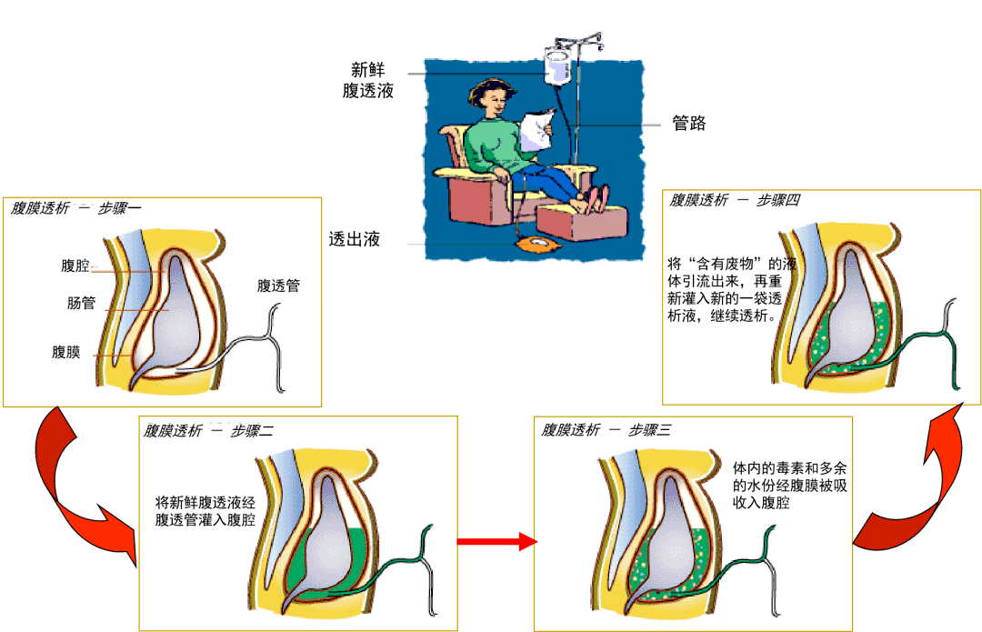 腹膜透析:助尿毒症患者 迎来新生活