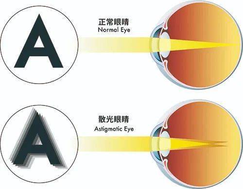 图1:正常眼睛和散光眼睛对比图散光是指平行光线经过眼球的屈光系统