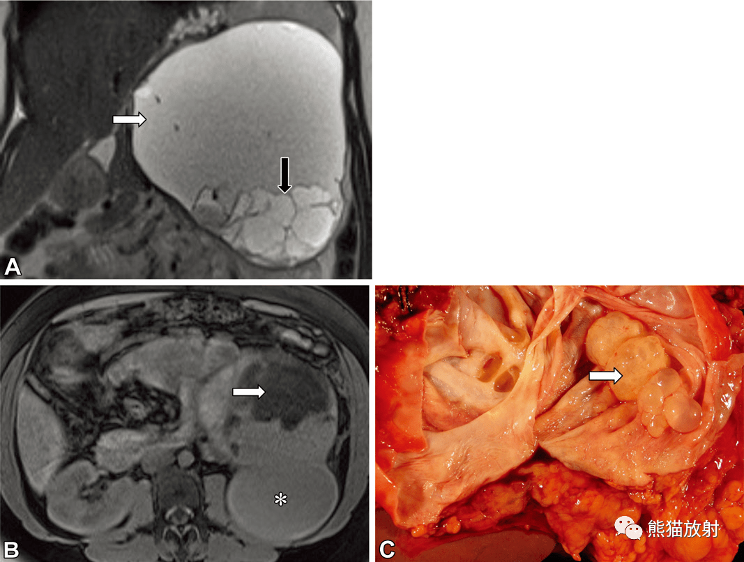腹盆部产生粘液肿瘤丨疾病种类及mri表现_显示_阑尾_信号