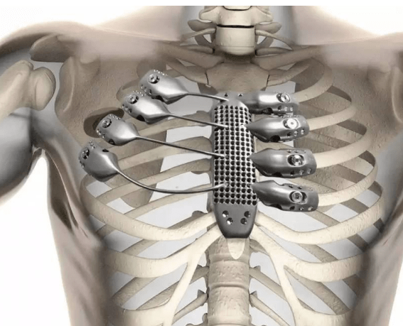 【科技前沿】3d打印钛合金人体骨骼,原来"换骨"术早就有了_技术_资料