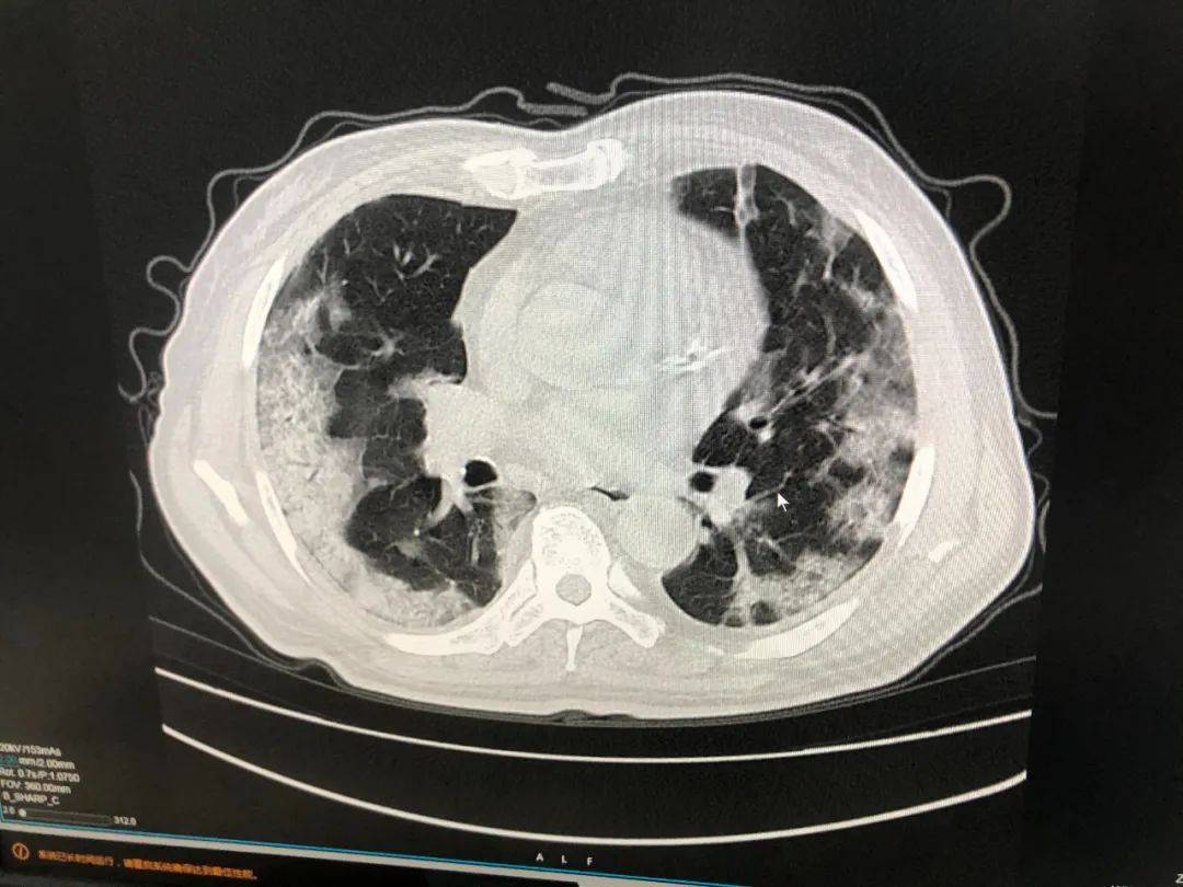 放射科技师俞洪梁拍片发现,一名73岁患者肺部显影呈一大片的白色状