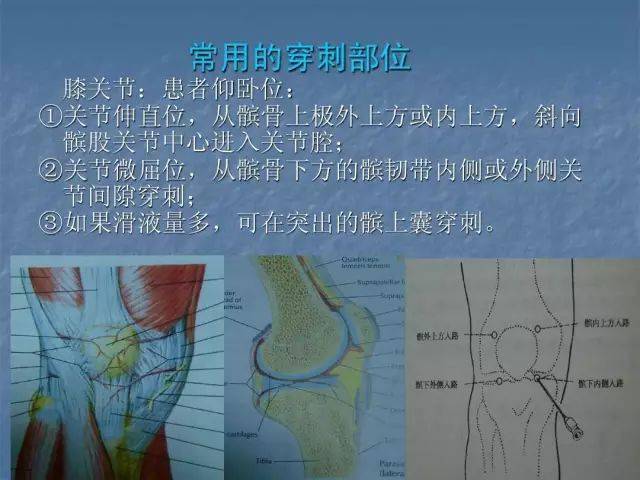 膝关节腔注射图解图片