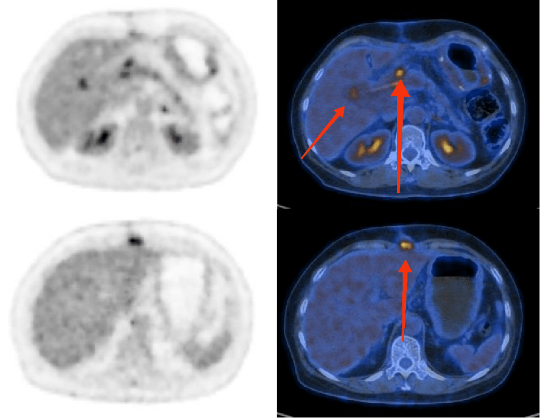 省医影像中心开展奥曲肽pet/ct显像_临床_病灶_患者