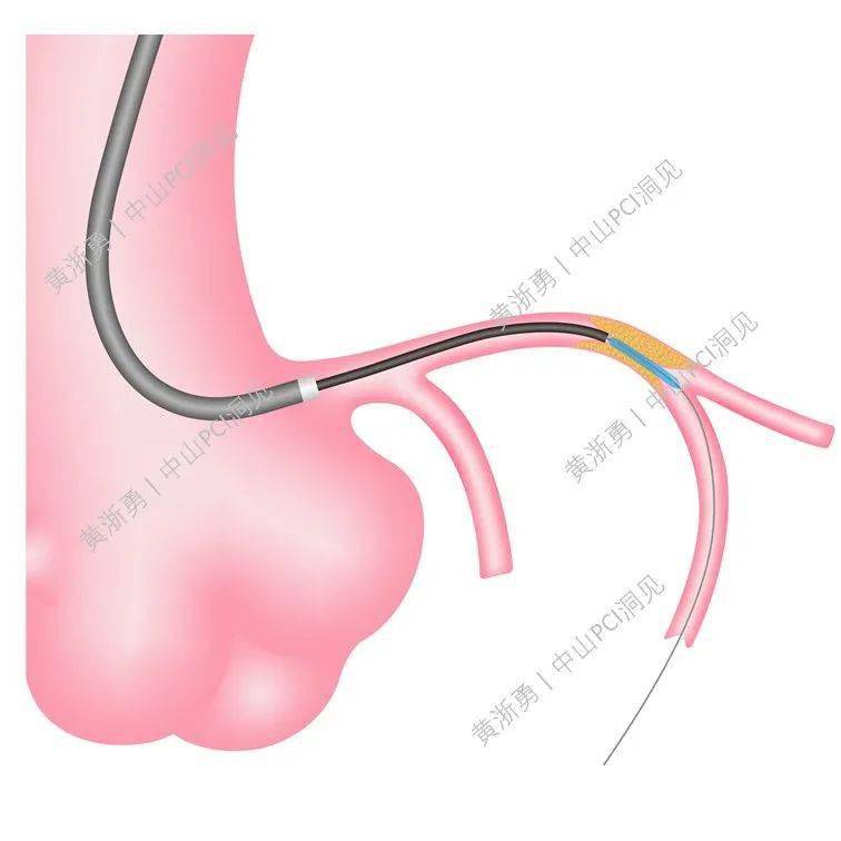 回撤器械,如何避免指引导管损伤冠脉?_黄浙勇_病变_阻力