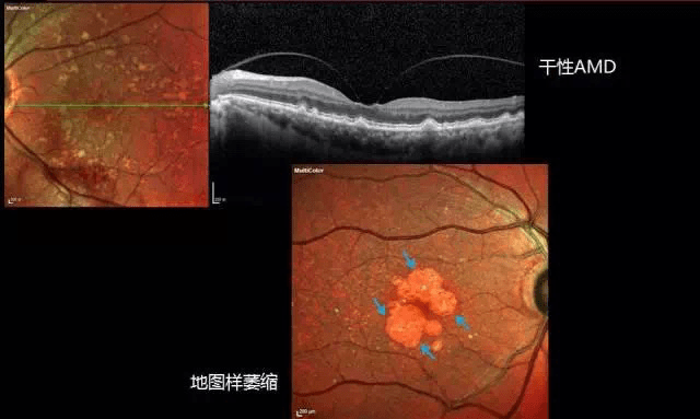 對於乾性amd的患者,炫彩成像可以更加清晰的顯示玻璃膜疣的細節及數量
