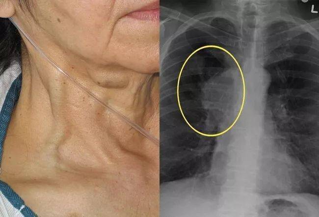 上腔静脉综合征可能会导致气道受压,喉头水肿,胸腔积液和脑水肿.