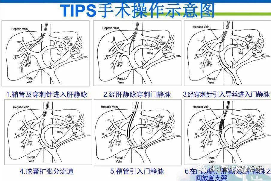 门体分流手术图解图片