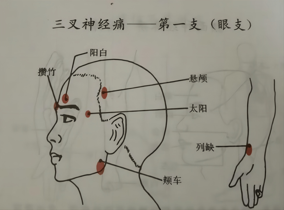 三叉神经痛的针灸图解图片