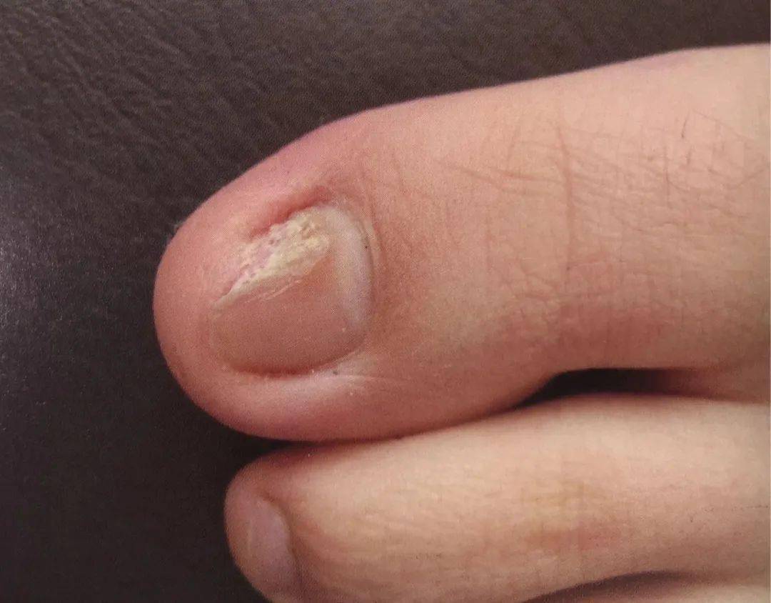 灰指甲不治疗会怎么样?有图有真相_医生_病情_诊断