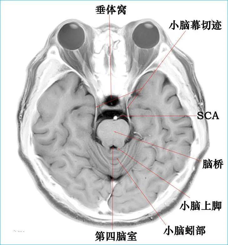 核磁头颅解剖图图片