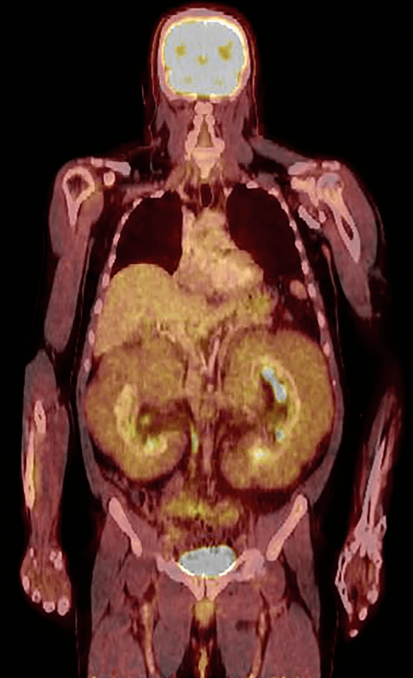 ��ë������������ʶErdheim-Chester ��