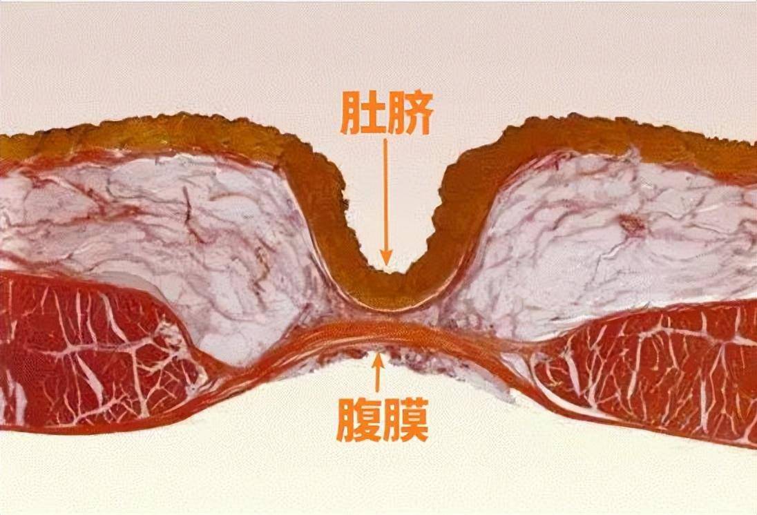 肚脐的形状图文解说图片