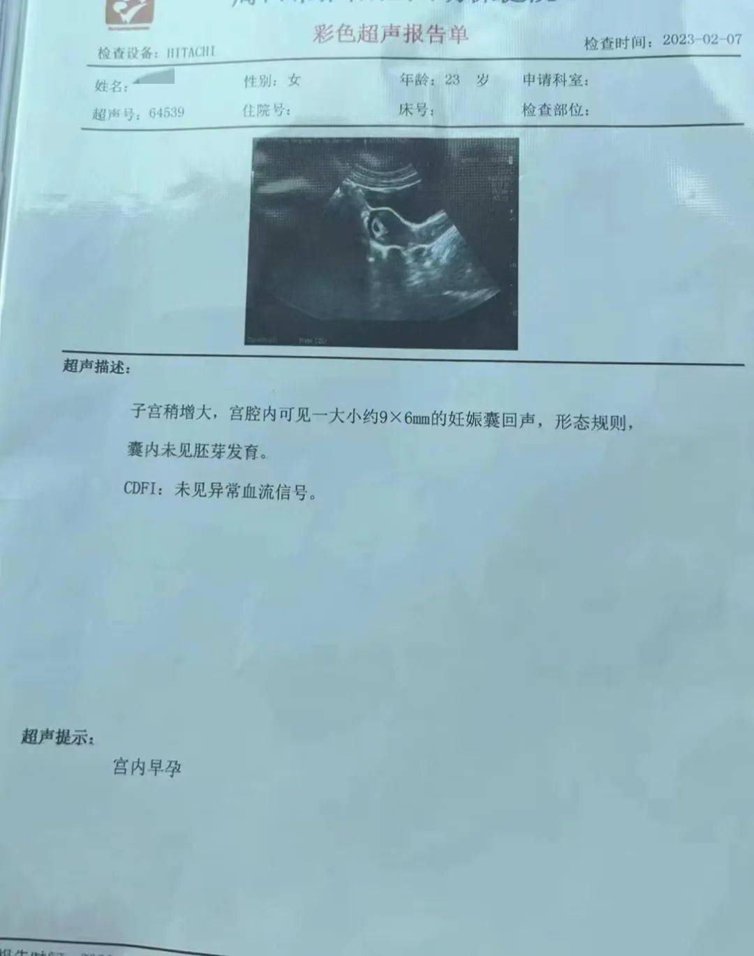 婚后2年未孕,原来是巧克力囊肿在"搞事情"!