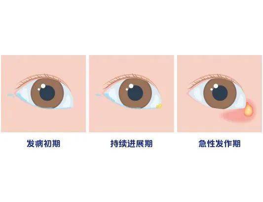 【科普】"女孩流泪8年发现泪道阻塞"冲上热搜,婴幼儿泪囊炎该如何对待