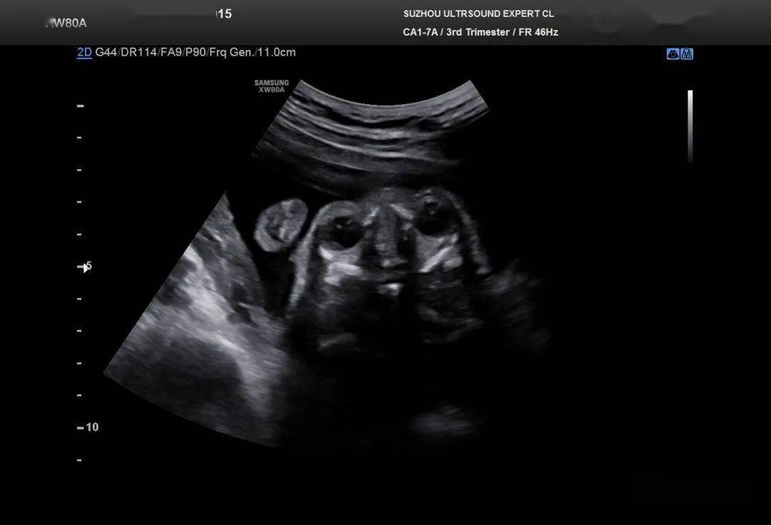 胎儿鼻骨发育不良_综合征_染色体_软指标