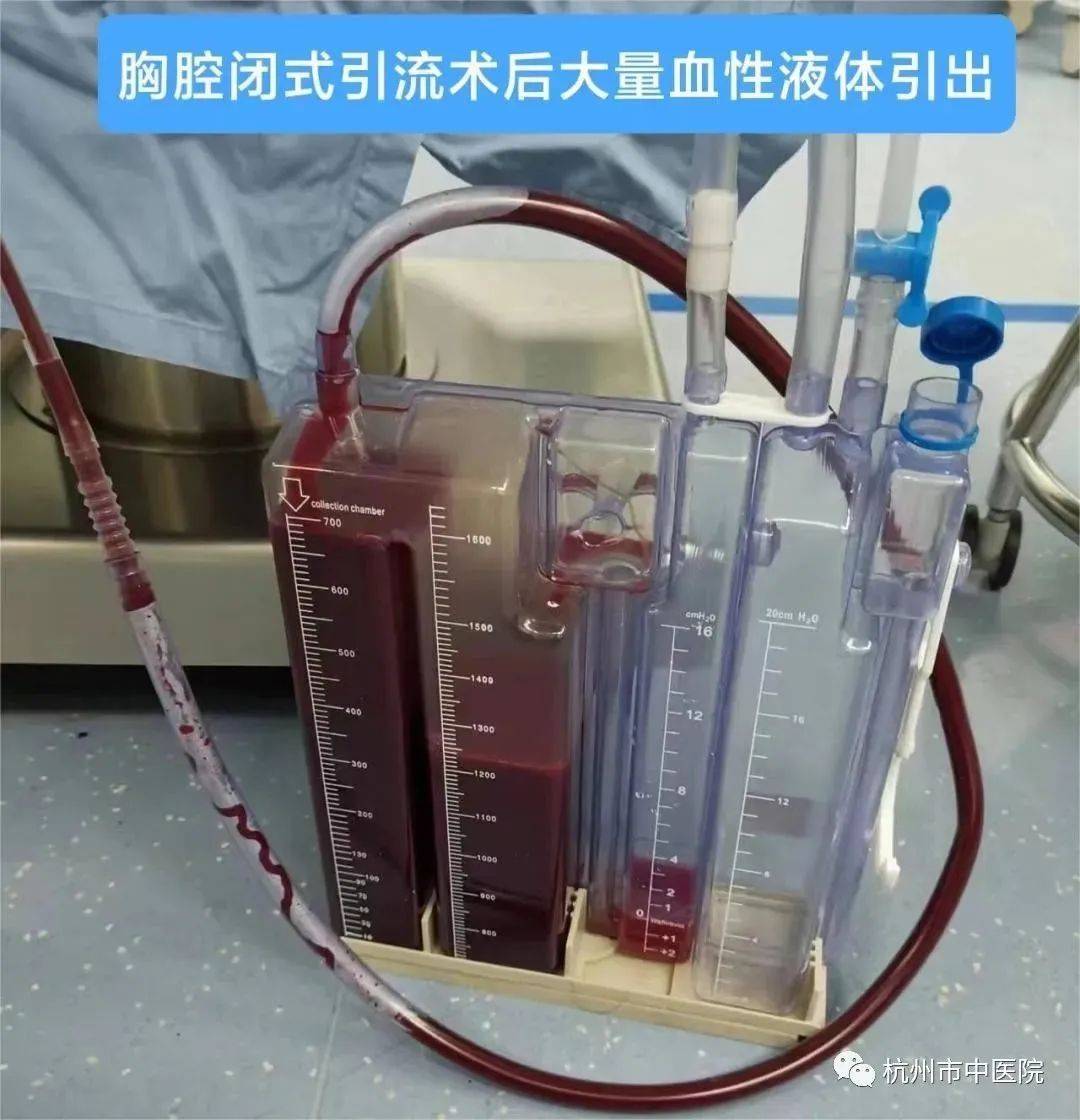 气胸x线胸片报告图片