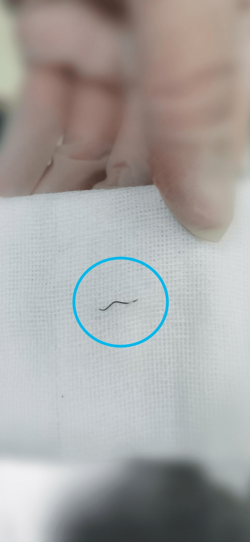 铁丝直穿左眼球,州医院眼科团队协力取出"眼中钉"_患者_手术_医生