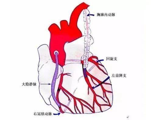 井陉县医院开展"心脏搭桥术"._患者_冠状动脉_成功