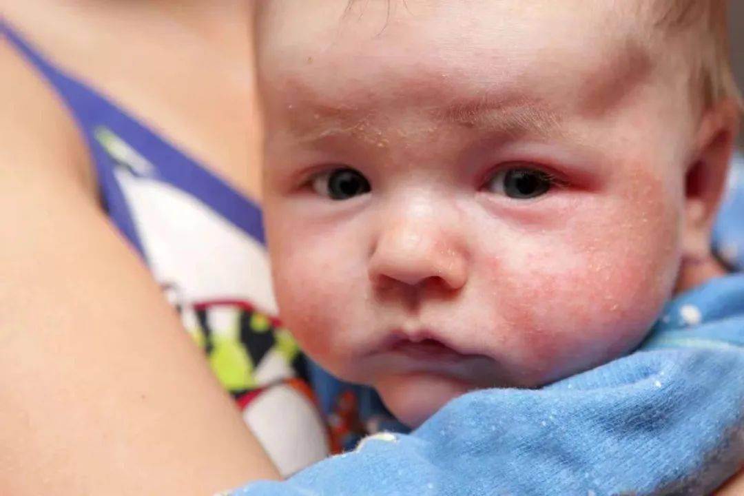 婴儿湿疹的诱发因素 如何缓解?