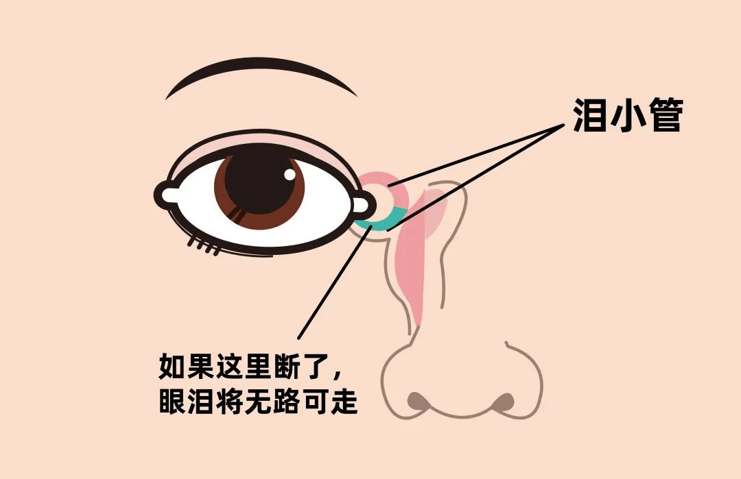 3岁男童泪管断裂辗转300公里,泪道专家巧手接泪管_小管_小恒_手术