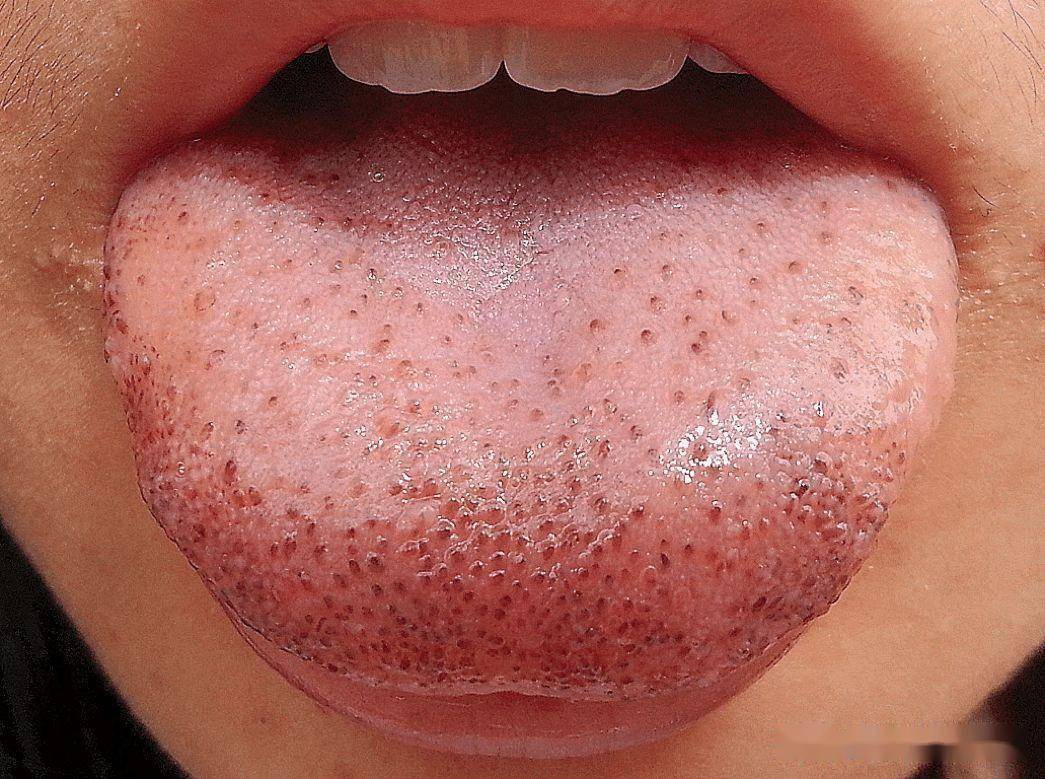 舌头有黑点是什么原因图片