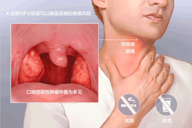 耳鼻喉科的扁桃体也有几种,一种是最常见的,位于口咽部腭舌弓和腭咽弓