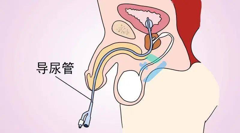 留置尿管卡通图片