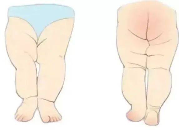 臀纹或大腿纹不对称,甚至双下肢不等长,是婴幼儿髋关节发育异常的早期