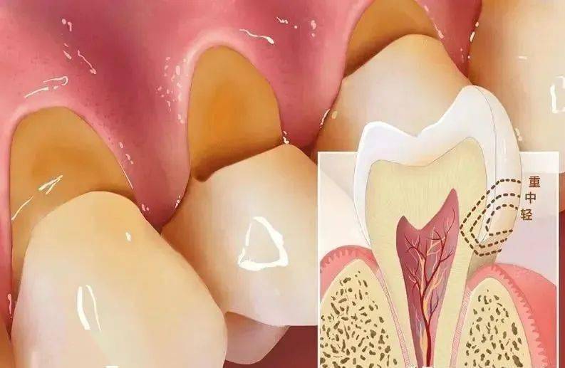 ②缺損達牙本質後,可導致牙本質過敏症,即牙齒接觸到冷熱酸甜或機械