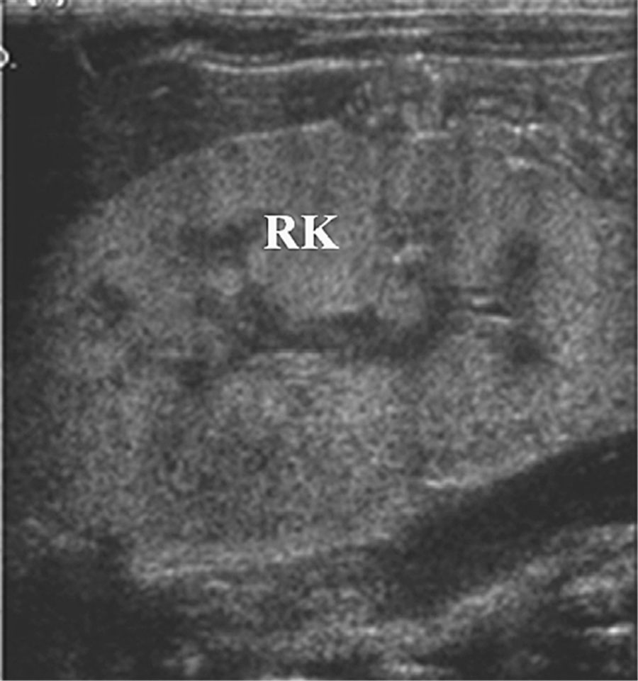 ARPKD 1697 15 arpkd-1697-15