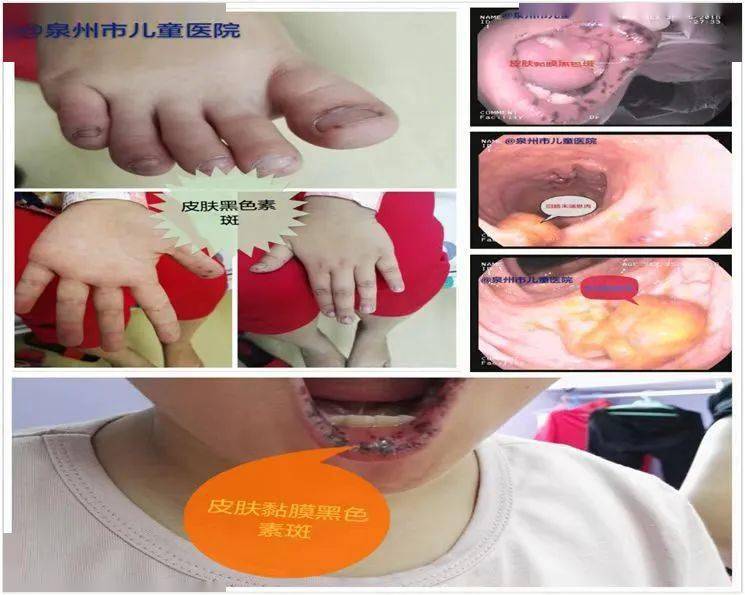 黑斑息肉综合征被称作波伊茨-耶格综合征(peutz-jeghers syndrome,pjs