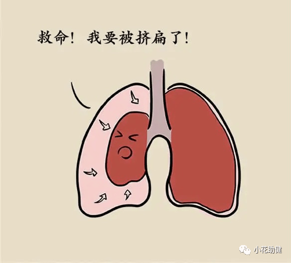 血气胸如何护理?_胸腔_移位_空气
