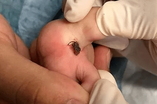 踏青归来,脚趾里钻进一只虫!杭州12岁姑娘慌了._医生_皮肤_部位