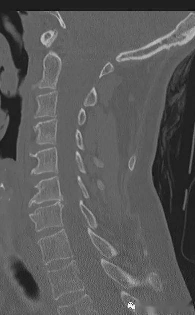 一直误认为是项韧带钙化._解剖_颈部_原文