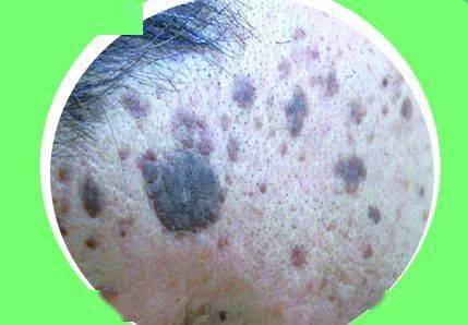 皮肤上密集的黑斑 其实是消化道在报警_郑女士_内镜_口唇