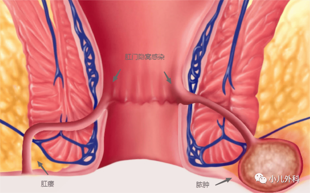 肛周脓肿的清晰图片图片