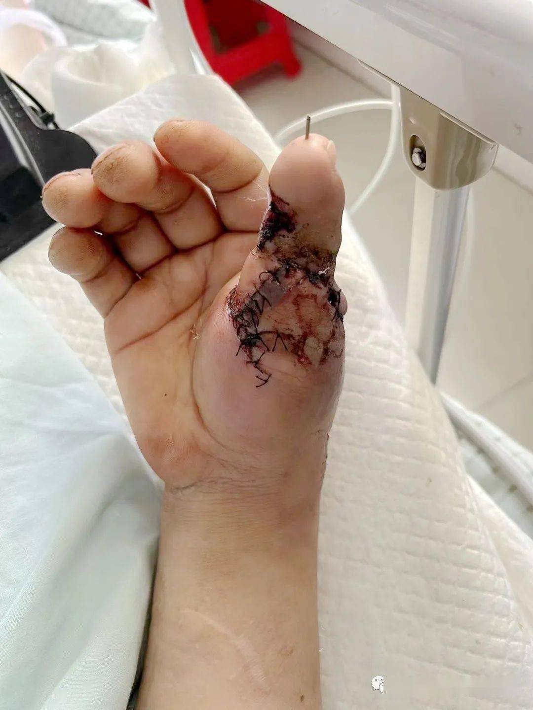 神奇!把脚趾移植到手上,这画面不敢想象