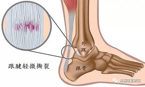 跟腱痛的相关解剖,疾病类型和发生机制(炎症,血管,神经和生物力学)