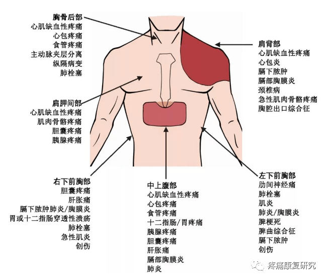 肋软骨炎示意图图片