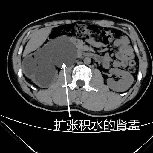 23岁小伙右肾萎缩