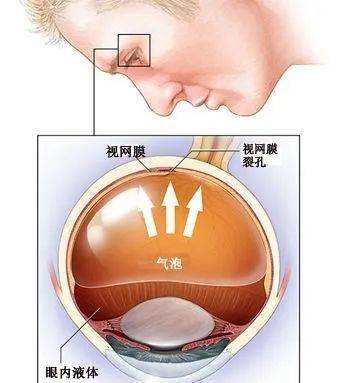 【眼科科普】为什么视网膜脱离术后要趴着睡?_气体_患者_手术