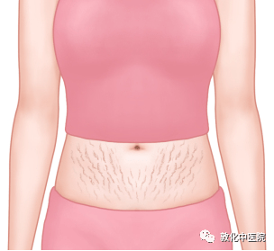 妊娠纹,生长过快所致的膨胀性萎缩纹;3.