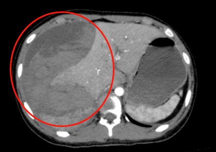 肝脏破裂ct图片图片